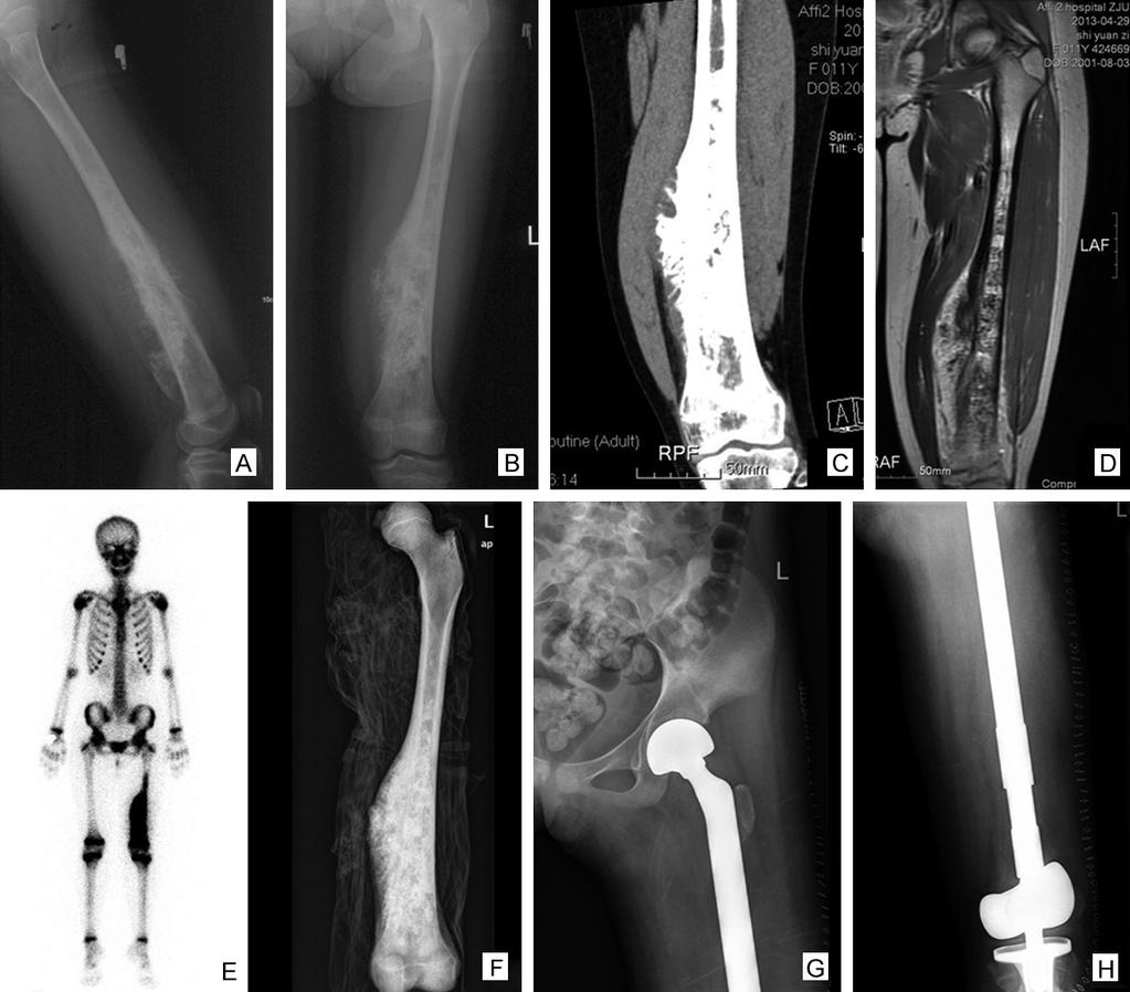 Figure 2. A 13-year-old girl suffered an osteosarcoma at the left femur. In X-ray, there was a tumor at the lower end of femur (A, B).