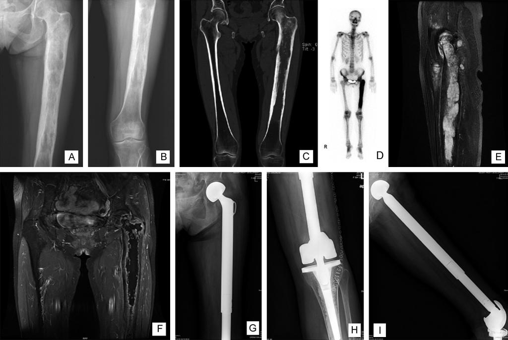 Figure 3. A 60-year-old woman suffered a chondrosarcoma at the left femur. The X ray, CT and ECT showed that tumor involved almost the whole femur (A-D).
