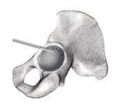 the fit, contact and congruency of prepared acetabulum. 3.