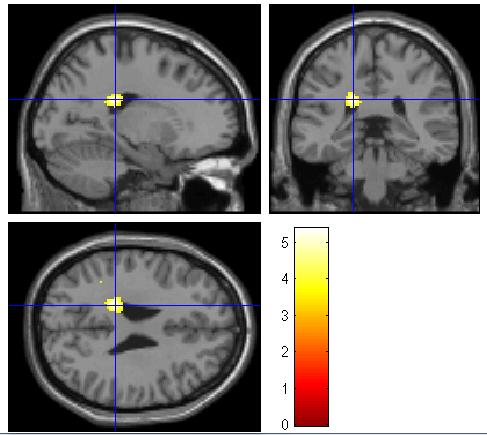 cortex; insula) and Memory (hippocampus) Philanthropy is a SOCIAL act using the mechanisms of