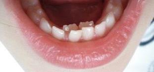 Eruption of permanent teeth: 1) Lingual eruption of mandibular permanent incisors: - It s a very common phenomenon. - It s a cause of concern to parents.