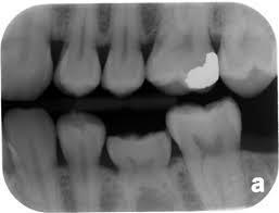 usually follow up or exert pressure using orthodontic appliances to push them anteriorly. 2) Ankylosed primary molars: - They are also referred to as Submerged Teeth or Teeth Infraocclusion.