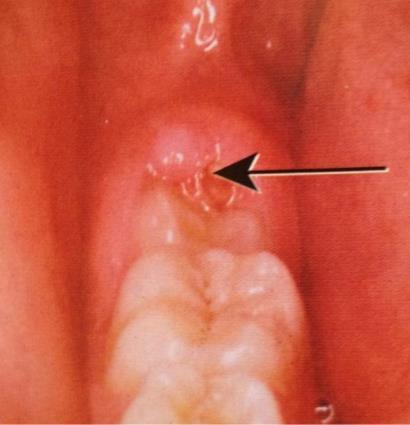 3) Eruption Sequestrum: - Seen in children at the time of eruption of the first permanent molars.
