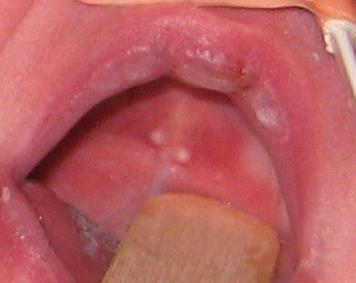 Common findings of the oral mucosa of newborns: 1) Epstein Pearls: They are small white/greyish lesions. They occur in about 80% of neonates. They are formed along the midpalatine raphe.