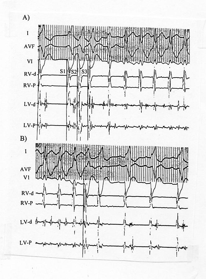 Recordings of bipolar electrograms from the RV and LV from a Patient with inducible Monomorphic VT showing late potentials from LV sites during Sinus rhythm and Fractionated diastolic Potentials