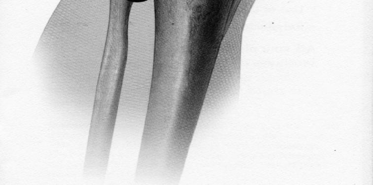 knee. It is a minimally invasive surgical procedure which uses an Arthroscope and other