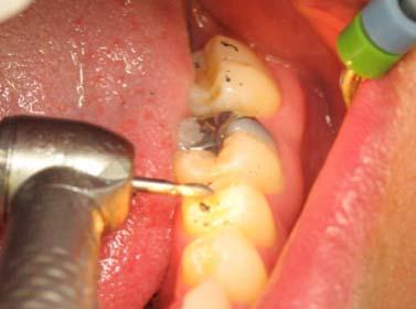 When you see a super-eupted tooth in a patient, does the gingiva follow the