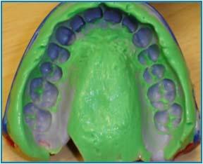 Interocclusal space, and