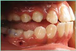 Procline maxillary teeth B. Retrocline mandibular teeth C.