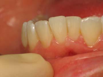 Failure of 4 or 6 anterior teeth to