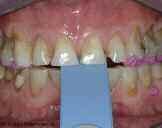 Figure 7: An intraoral composite mock-up was performed to establish the ideal length for the central incisors.