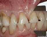 Tooth preparation Following a two-month period of periodontal healing and maturation, the patient was scheduled for appointments on two