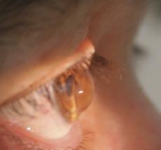 positioning during use, scleral lenses offer the maximum optical performance.