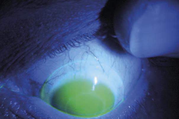 EPSILON diagnostic lenses have 350 microns