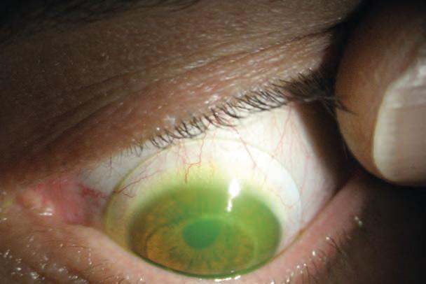clearance Scleral zone alignment is