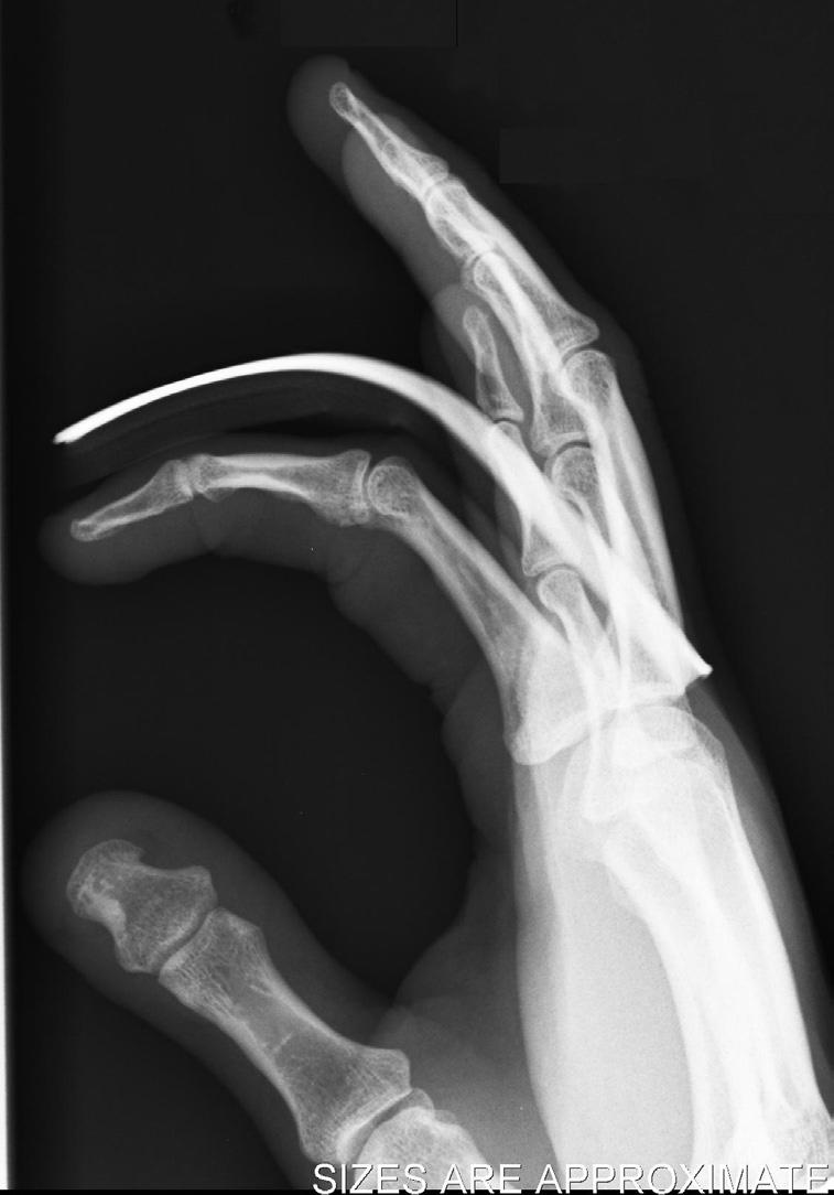 Figure 3. A stable proximal interphalangeal joint dislocation that was reduced and splinted in flexion using a dorsal aluminum splint. Note the normal joint congruity (arrow).