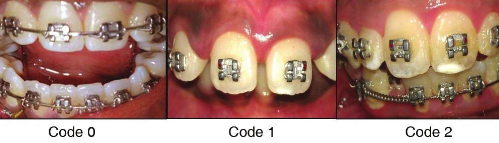 0to6 (0-sound tooth surface, 1-first visual change in enamel, 2-distinct visual change in enamel, 3-initial breakdown in enamel, 4-underlying dark shadow from dentin, 5-distinct cavity with visible