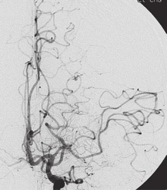 126 a b c d e Fig. 15.1 Giant serpentine aneurysm.
