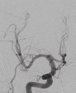 If we select distal approach especially in upward direction M1 aneurysm, we cannot capture proximal M1 safely prior to aneurysm.
