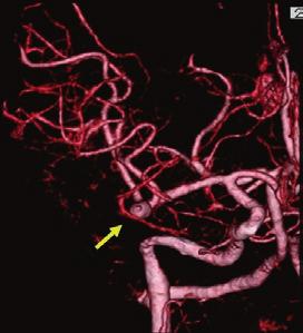 In the standard transsylvian approach, it is important to remember that the aneurysm usually is located more superficially.