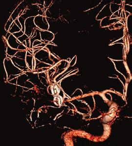 In these cases, if we select the conventional transsylvian approach, we may seize the aneurysm before internal carotid artery. So we need not see the internal carotid artery.