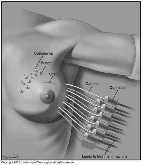 Page 8 Page 9 Placement of the Treatment Catheters When your procedure starts, your breast will be numb from the Emla cream. First, an ultrasound will be performed to identify the lumpectomy cavity.