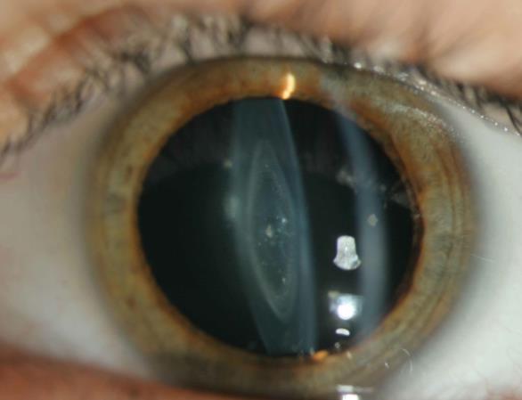 Pediatric Cataracts: Complicated Cases and Controversies M. Edward Wilson, M.D. N.