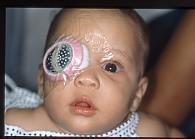 royalties Cataract surgery in children Cataract surgery in children General anesthesia is