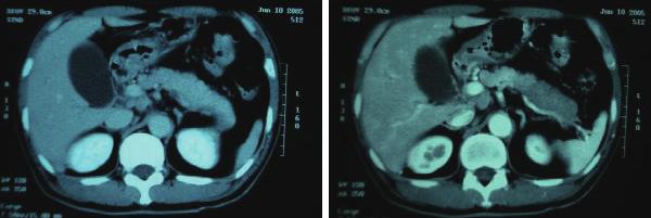 Figure2. Arterialphase(left)andvenousphase(right)ofanabdominalCTscanshowsinflam matoryswelingfrom thebodytothetailofthepancreas.pancreaticswelingdisappearedafter PSLtherapy. Figure3.