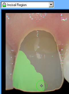 Region for the tooth. When defining the incisal region cropping will be displayed with the color green. 7.