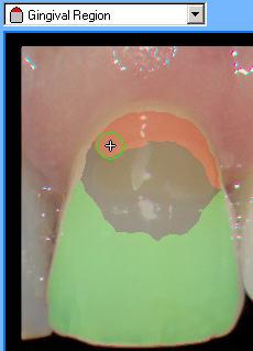 Select the Gingival Region from the drop-down list and use the crop tool to select the desired Gingival Region for the tooth.
