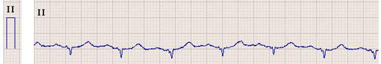 By analyzing low amplitude oscillations of conventional ECG signals, we can generate a stable signal of ECG micro