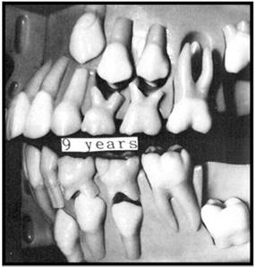 Primary Teeth Named for letters of the alphabet.