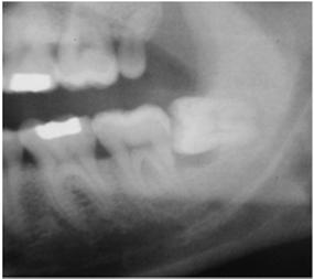 Third Molars : Nos. 1,16,17,32 Only 2% of the population have sufficiently erupted.