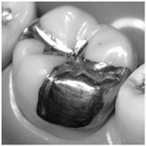Dental Restorations Slide 46 What is an Amalgam?