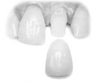 damaged tooth Requires custom fabrication Porcelain Anterior Gold
