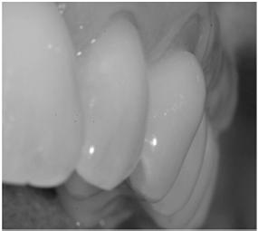 Toothbrush Abrasion Acquired Defect V shaped at gingival