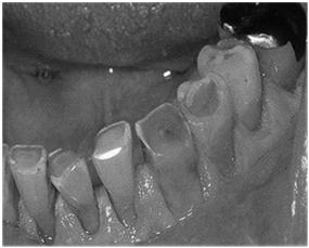 Normal Variant: Acquired Defect, Attrition Loss of tooth structure on the Occlusal or