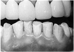Variant: Abrasion from Prosthesis Loss of tooth structure from mechanical wear