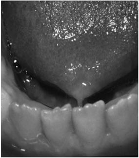 treatment Slide 64 Normal Variant :Ankyloglossia Tongue tied