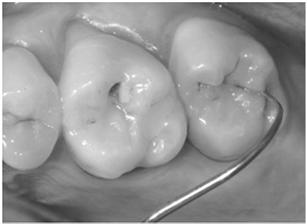 lingual mesial, middle, distal Start at tooth #1 16, then #17 32