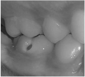 77 Explore for Decay Check the buccal pits on first molar teeth Check