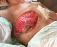 Special site: PG after breast surgery Bilateral PG following breast explantation Special site: PG after breast