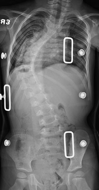 4+4 y/o Treatment: 9 spine castings 3 TLSOs 74 o