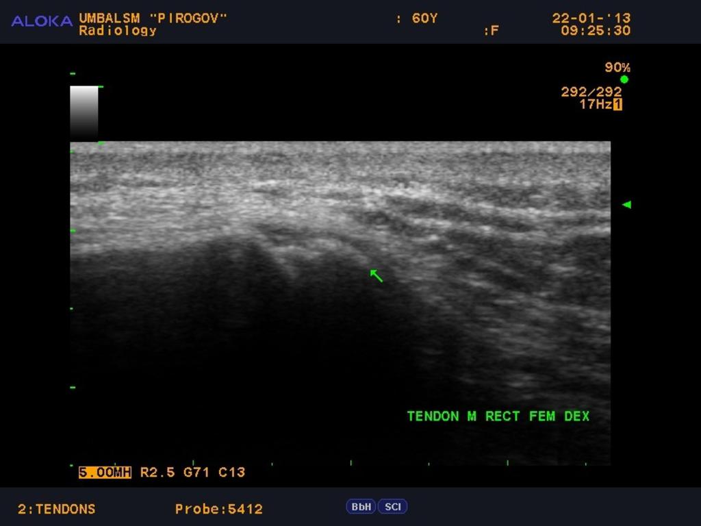 Fig. 3: Chronic knee pain, knee joint ultrasound -