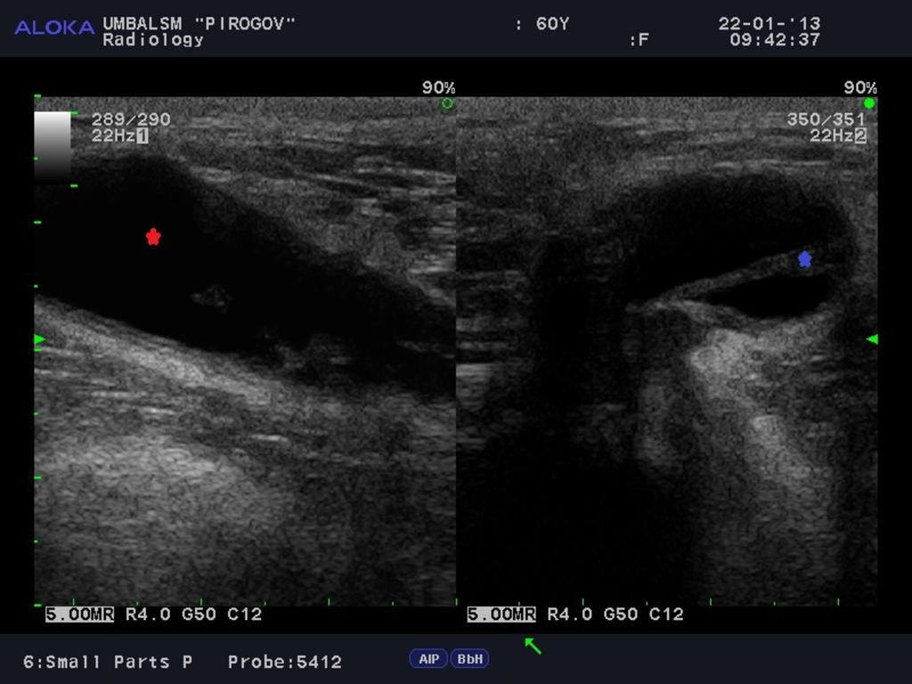 Fig. 4: Chronic knee pain, knee joint ultrasound -