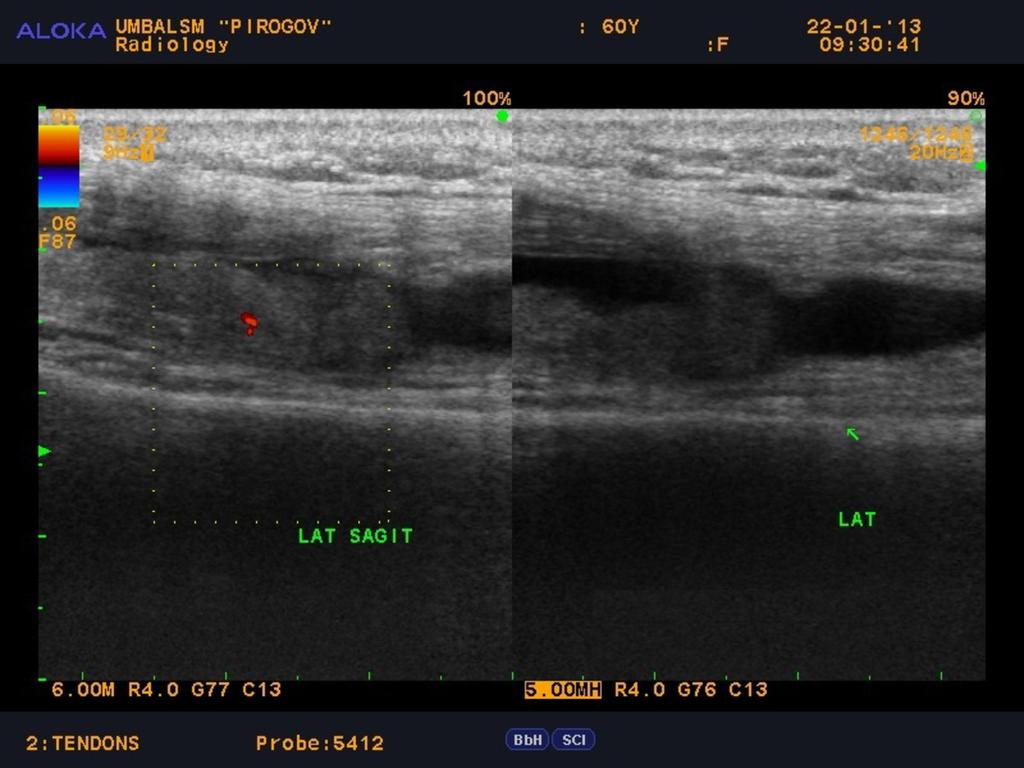 Fig. 5: Chronic knee pain, knee joint ultrasound with Doppler-