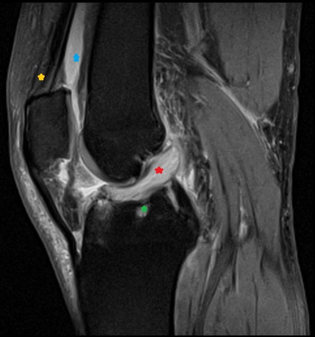 Fig. 6: Chronic knee pain, MRI, sagittal PD TSE with fat saturation - ACL mucoid degeneration (red star),