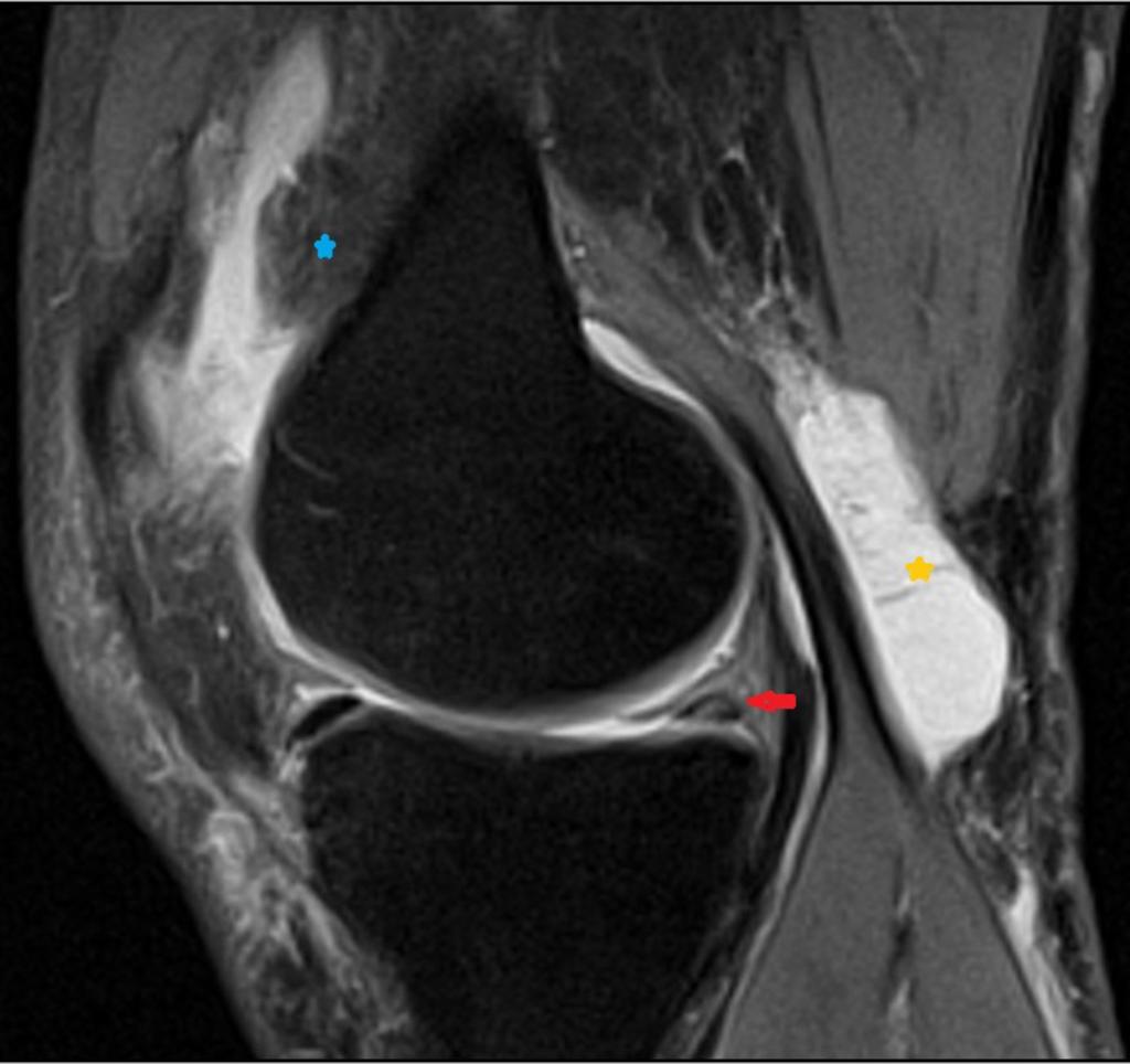 Fig. 7: Chronic knee pain, MRI sagittal PD TSE with fat saturation - Baker's cyst with thin septations (yellow star),