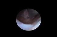Hysteroscopy with Polyp Removal Our KP Hysteroscopy experience.